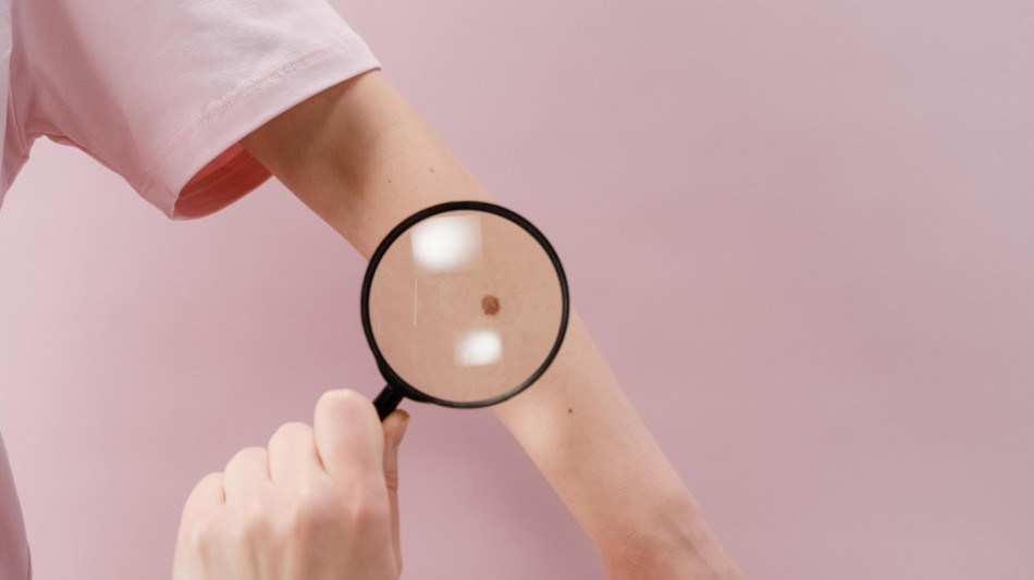 Intergruppo melanoma, 'bene la nuova legge su prevenzione e diagnosi precoce'