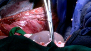 Un equipo médico de EEUU realiza otro trasplante de riñón de cerdo a humano